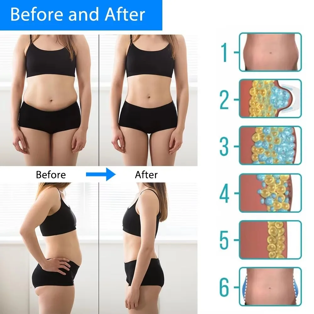 Aparelho Criolipólise Abdominal Terapia Frio - Imagem 4
