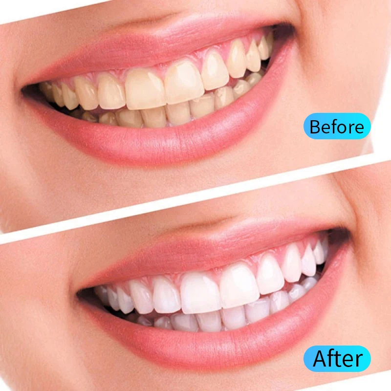 Kit Gel Clareador Dental Higiene Oral - Imagem 3