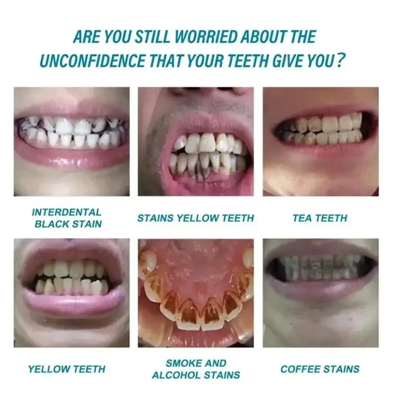 Soro para Limpeza e Branqueamento de Dentes - Imagem 4