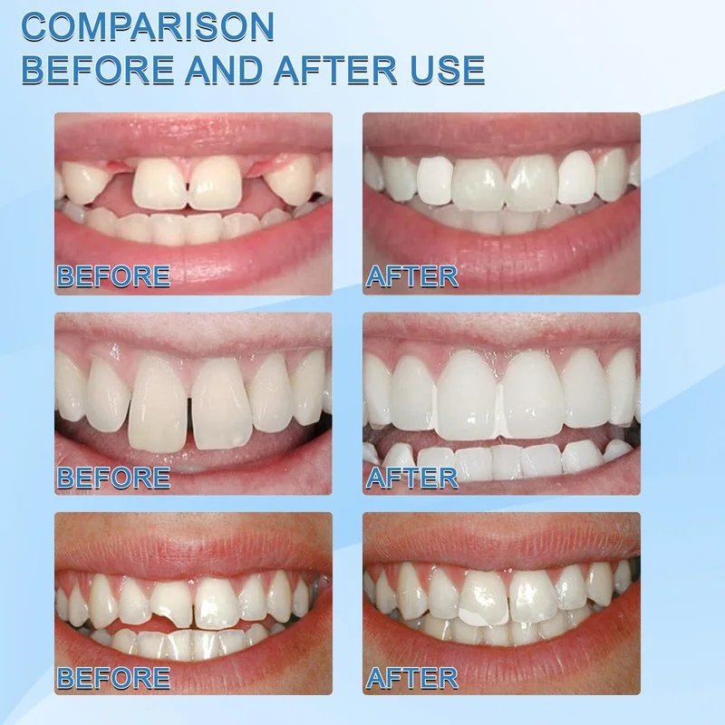 Pérolas Temporárias para Reparo Dental Branco - Imagem 6