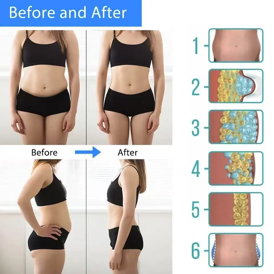 Massageador Abdominal Crioterapia Lipo Congelamento - Imagem 4