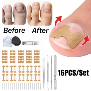 kit corretor de unhas encravadas