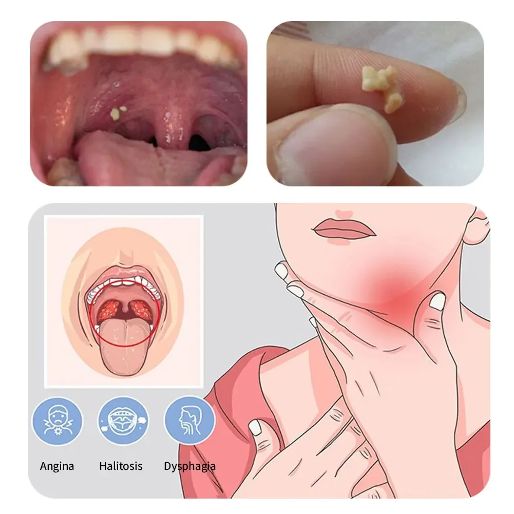 Removedor de Cáculo Amigdaliano Aço Inoxidável Manual - Imagem 3