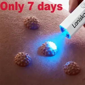caneta de luz azul para remoção de verrugas